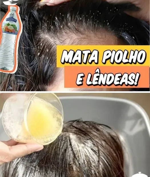 Como acabar com piolhos de um jeito muito barato e eficiente