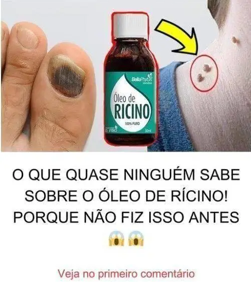 O Que Quase Ninguém Sabe Sobre o Óleo de Rícino! Porque Não Fiz Isso Antes