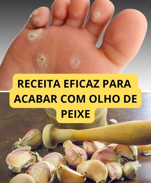 Tratamento Caseiro para Olho de Peixe